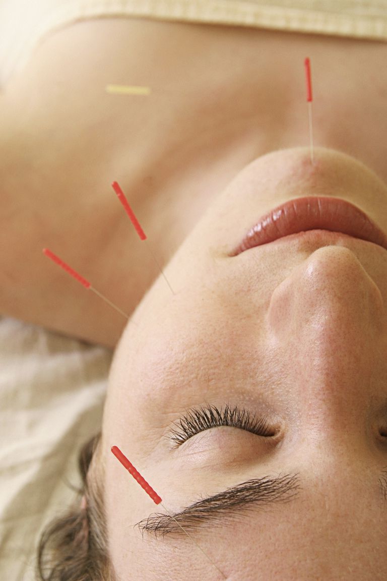Akupunktur Tedavisi Akne?