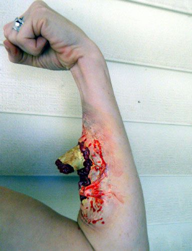 Protes latex wound
