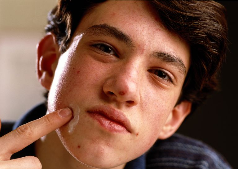 किशोर का boy (13-15) applying cream to acne, close-up