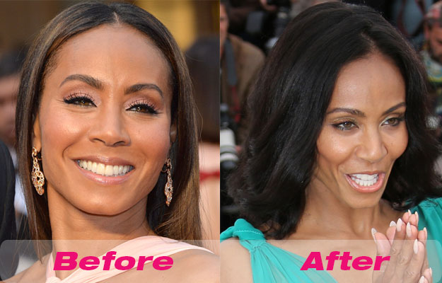 Jada Pinkett Smith Plastic Surgery Before and After