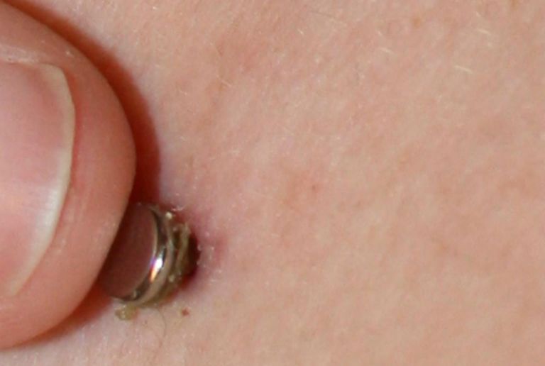 Vad ska man göra med infekterade piercingar